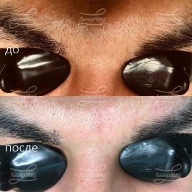 Лазерная эпиляция мужских бровей на Александритовом аппарате