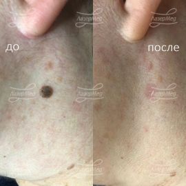 Удаление лазером себорейной кератомы в области шеи. Выполнила процедуру