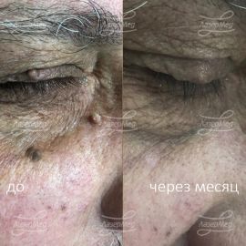 Удаление доброкачественных новообразований кожи лица ( папилломы, кожный рог)