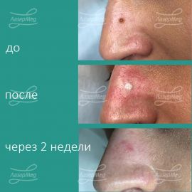 Удаление невуса области носа углекислотным лазером, диагноз подтверждён гистологически