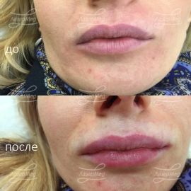Контурная пластика губ