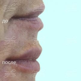 Контурная пластика возрастных губ