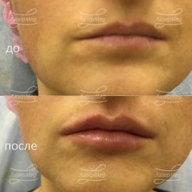 Коррекция ассиметрии и увлажнение губ