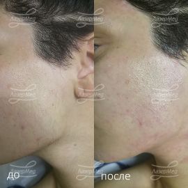 Лазерная эпиляция в области щек, висков