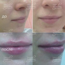 Коррекция объема губ