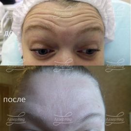 Коррекция морщин на лбу с применениями препаратов на основе ботулотоксина