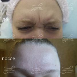 Коррекция морщин на межбровье с применениями препаратов на основе ботулотоксина