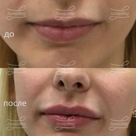 Коррекция объема губ