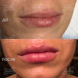 Коррекция объема губ