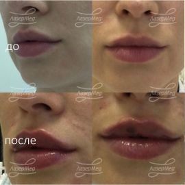 Коррекция объема губ