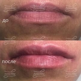 Контурная пластика губ