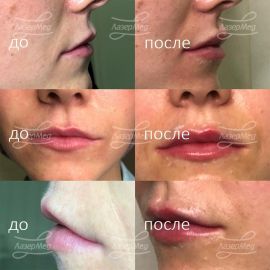 Контурная пластика губ, введён 1 мл геля на основе гиалуроновой кислоты