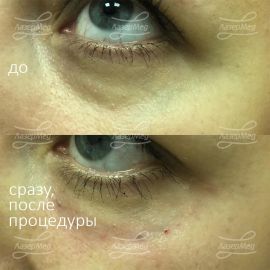 Коррекция носослезной и пальпебромалярной борозды гелем на основе гиалуроновой кислоты, введено по 0,35 мл с каждой стороны под связку, которая образует эти борозды