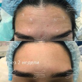 Ботулинотерапия мимических морщин кожи лба