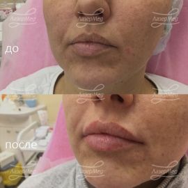 Коррекция объема губ препаратом на основе гиалуроновой кислоты