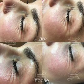 Коррекция мимических морщин в периорбитальной области