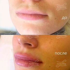 Коррекция объема губ препаратом Juvederm Ultra 3