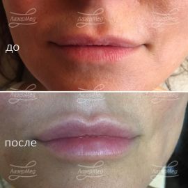 Коррекция объема губ