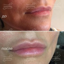 Коррекция объема губ