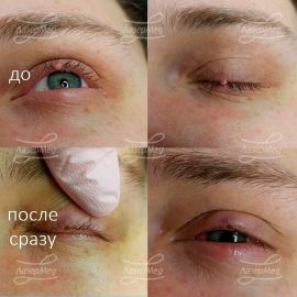 Лазерная деструкция папилломы на ресничном крае