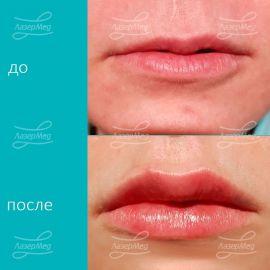 Контурная пластика губ