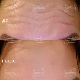 Коррекция мимических морщин ботулотоксином типа А