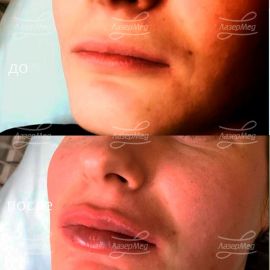 Коррекция объема губ