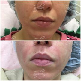 Коррекция носогубных складок препаратом на основе гиалуроновой кислоты