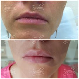 Коррекция объёма губ