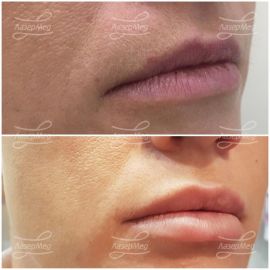 Коррекция объёма губ