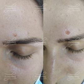 Удаление родинки