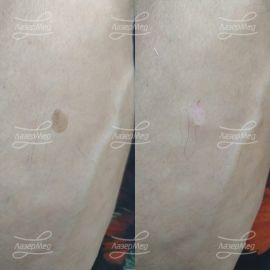 Удаление кератомы