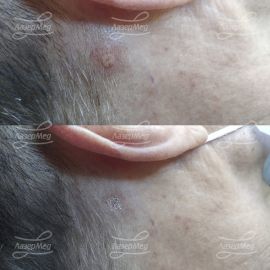 Удаление родинки