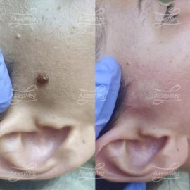 Удаление родинки