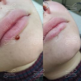 Удаление родинки