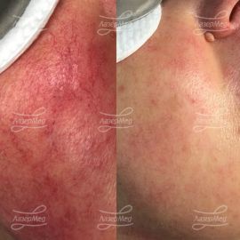 Лазерное удаление сосудов