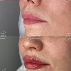 Коррекция объема губ