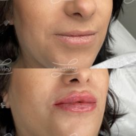 Коррекция объема губ