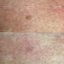 Лазерное удаление пигментных пятен