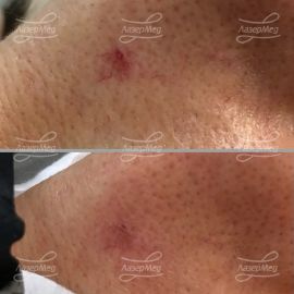 Лазерное удаление сосудов