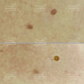 Удаление родинки