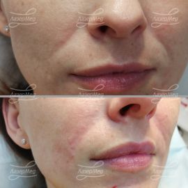 Коррекция носогубных складок препаратом на основе гиалуроновой кислоты