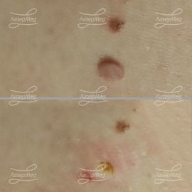 Удаление родинки до и сразу после