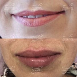 Коррекция объема губ