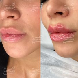 Контурная пластика губ