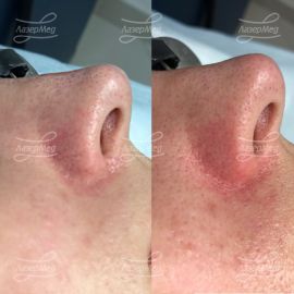 Лазерное удаление сосудов