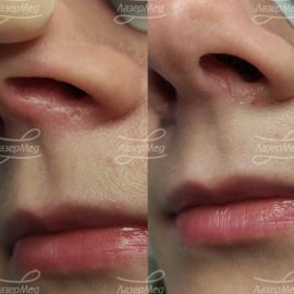 Лазерная коагуляция телеангиэктизий