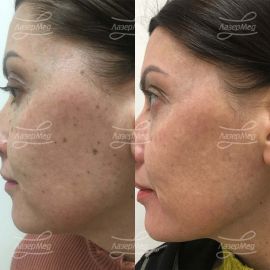 Лечение пигментных пятен