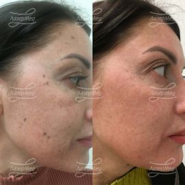 Лечение пигментных пятен