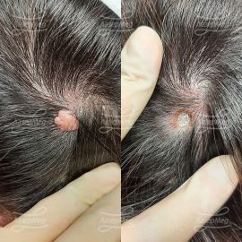 Удаление фибромы на волосистой части головы